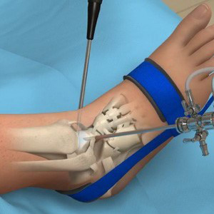 Ankle arthroscopy surgery