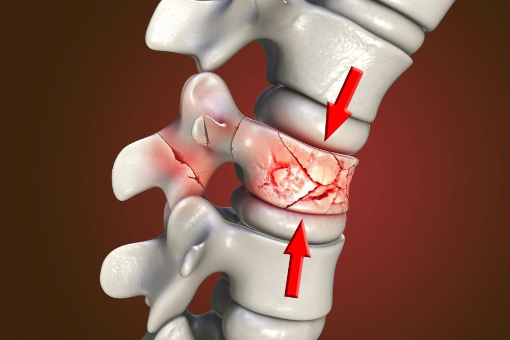 Traumatic vertebral fracture treatment