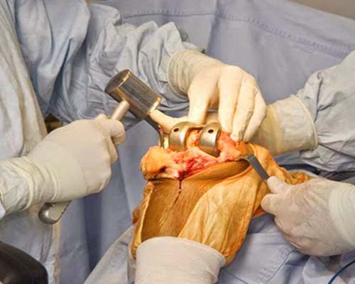 Elbow arthroscopy